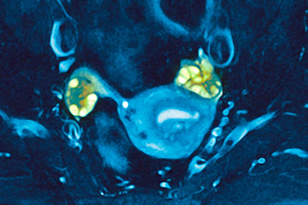PCOS May Delay Menopause and Boost Fertility After 40