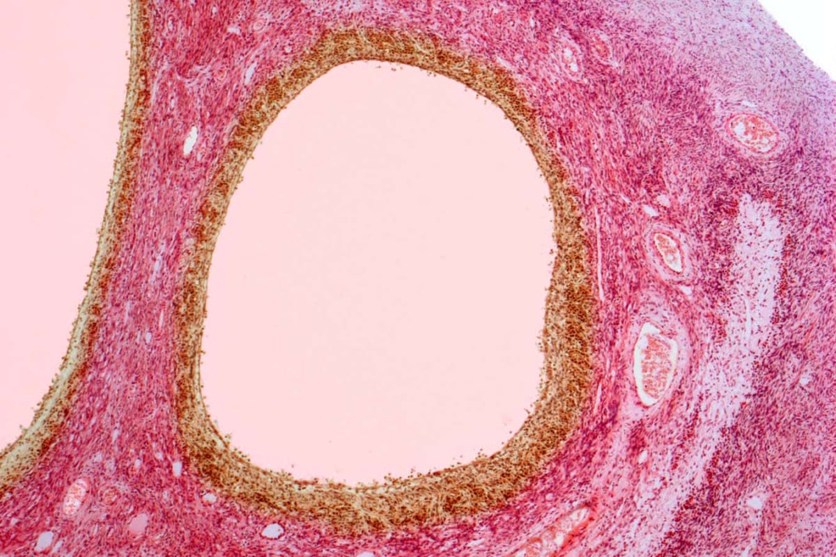 PCOS Gets New Name That Finally Explains the Condition