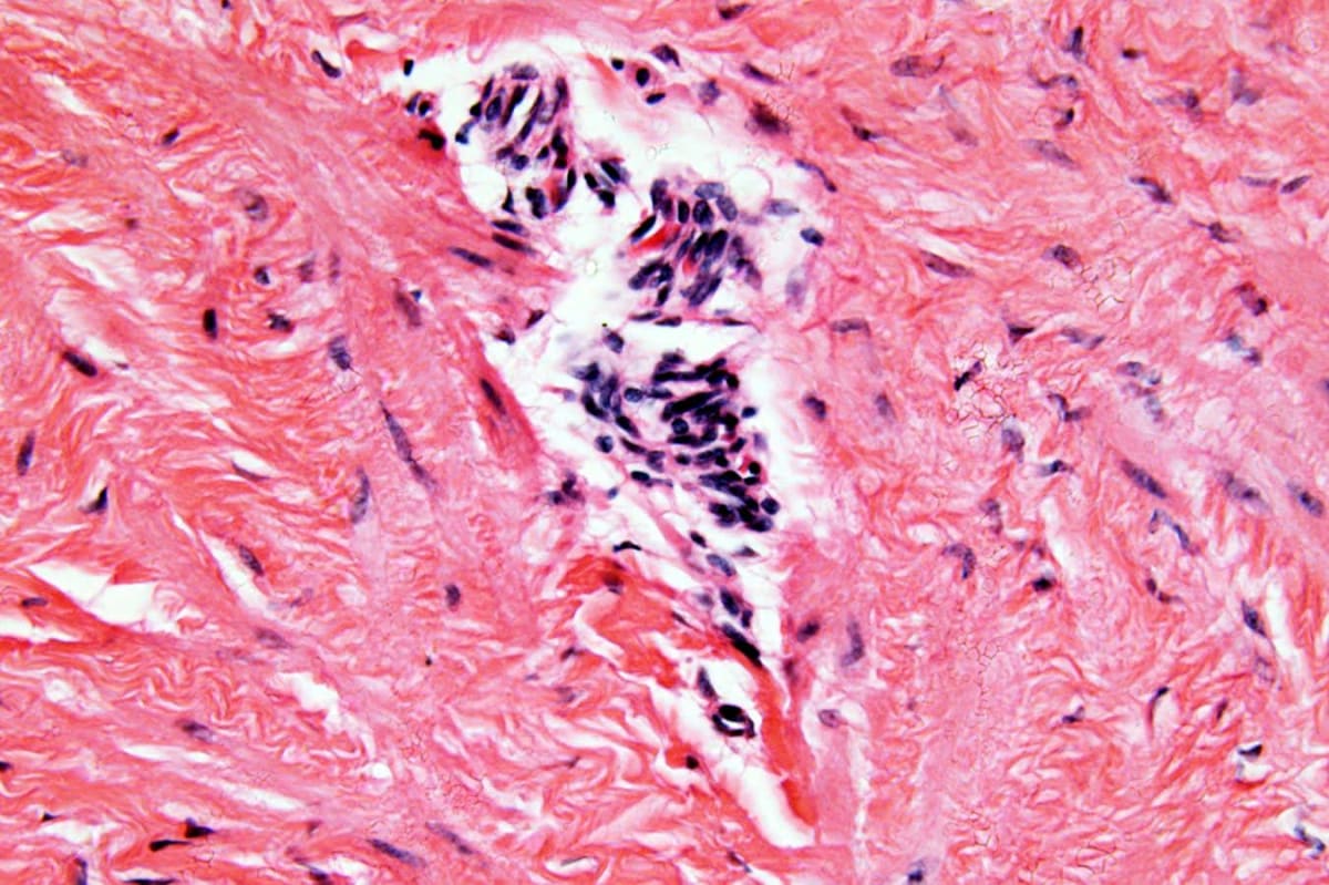 Microscope image showing ovarian tissue with endometriosis cysts for medical research study