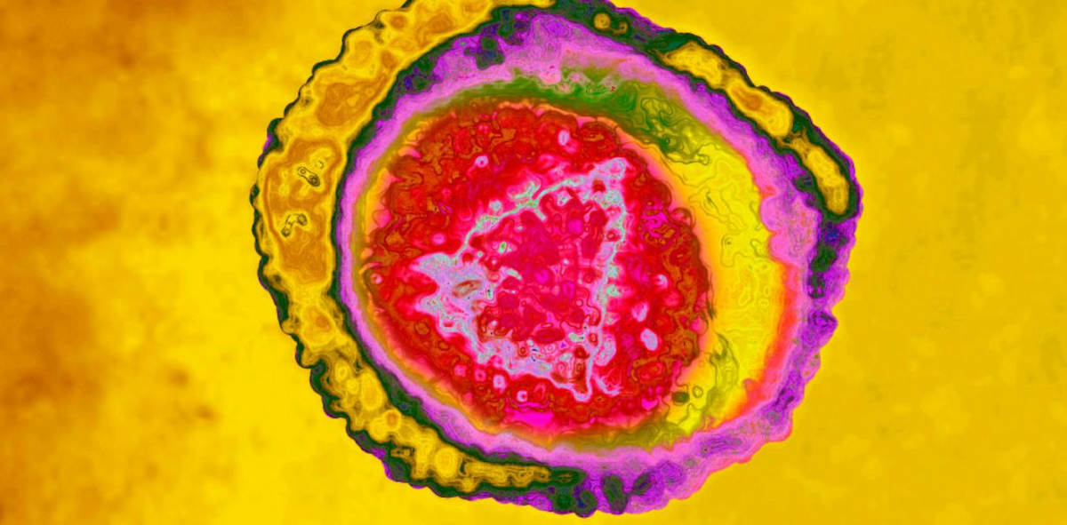 Scientists Find New Hope for Chronic Shingles Pain
