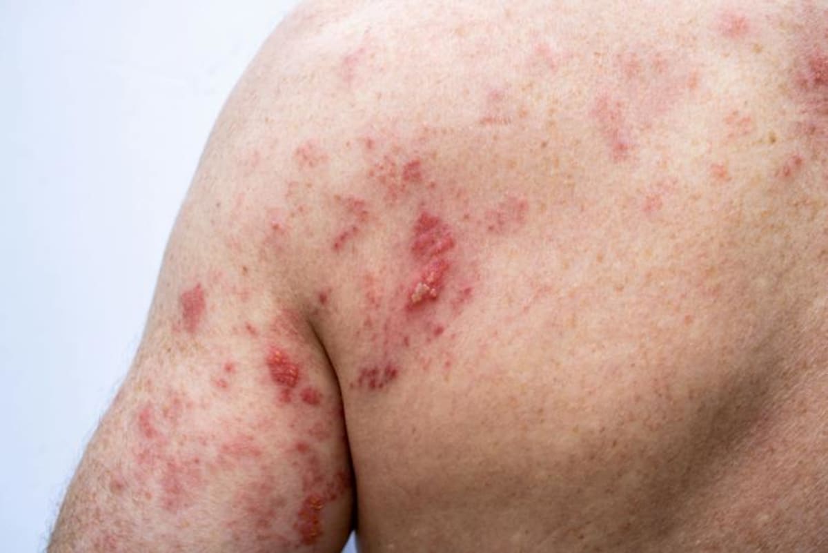 Scientists Find New Hope for Chronic Shingles Pain - Image 3