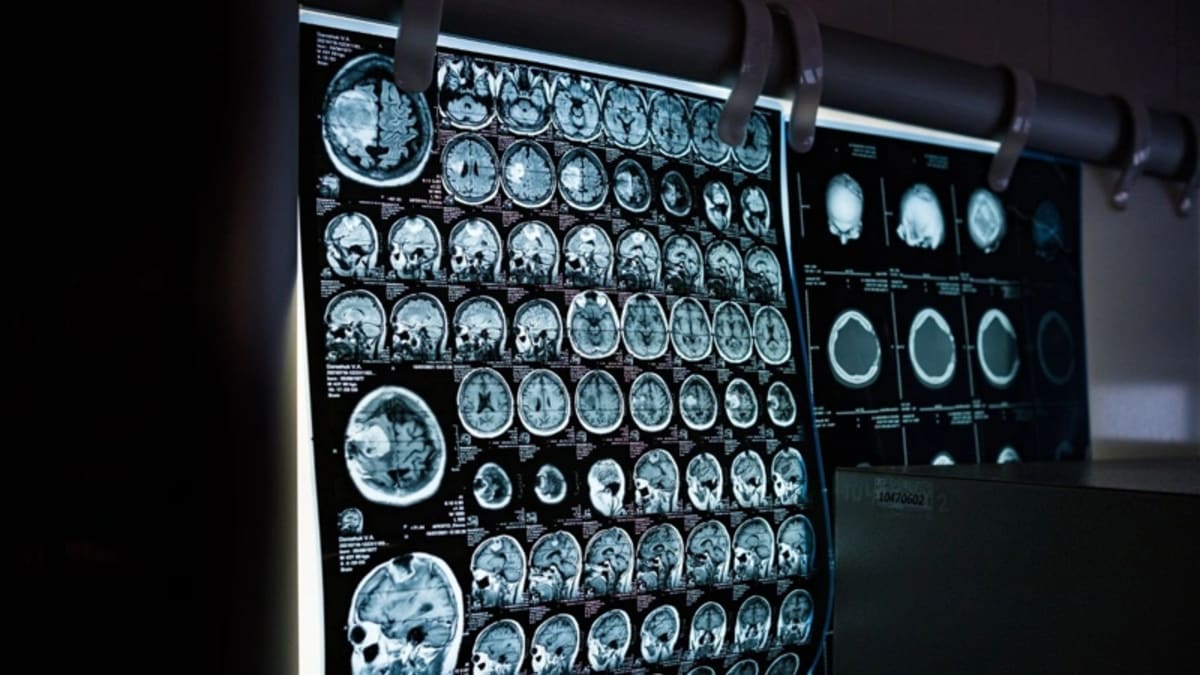 Scientists Find New Way Brain Cells Die in Alzheimer's - Image 2