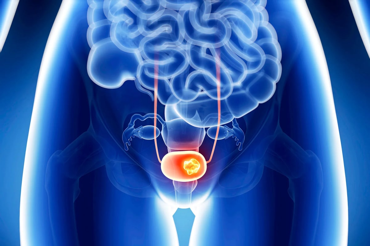 Bladder Cancer Treatment Leaps Forward with New Therapies