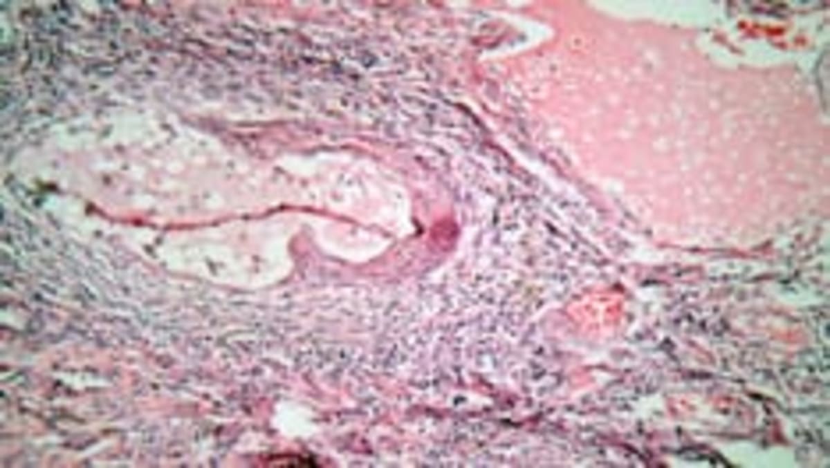 New Cervical Cancer Drug Extends Lives by 2 Months - Image 2