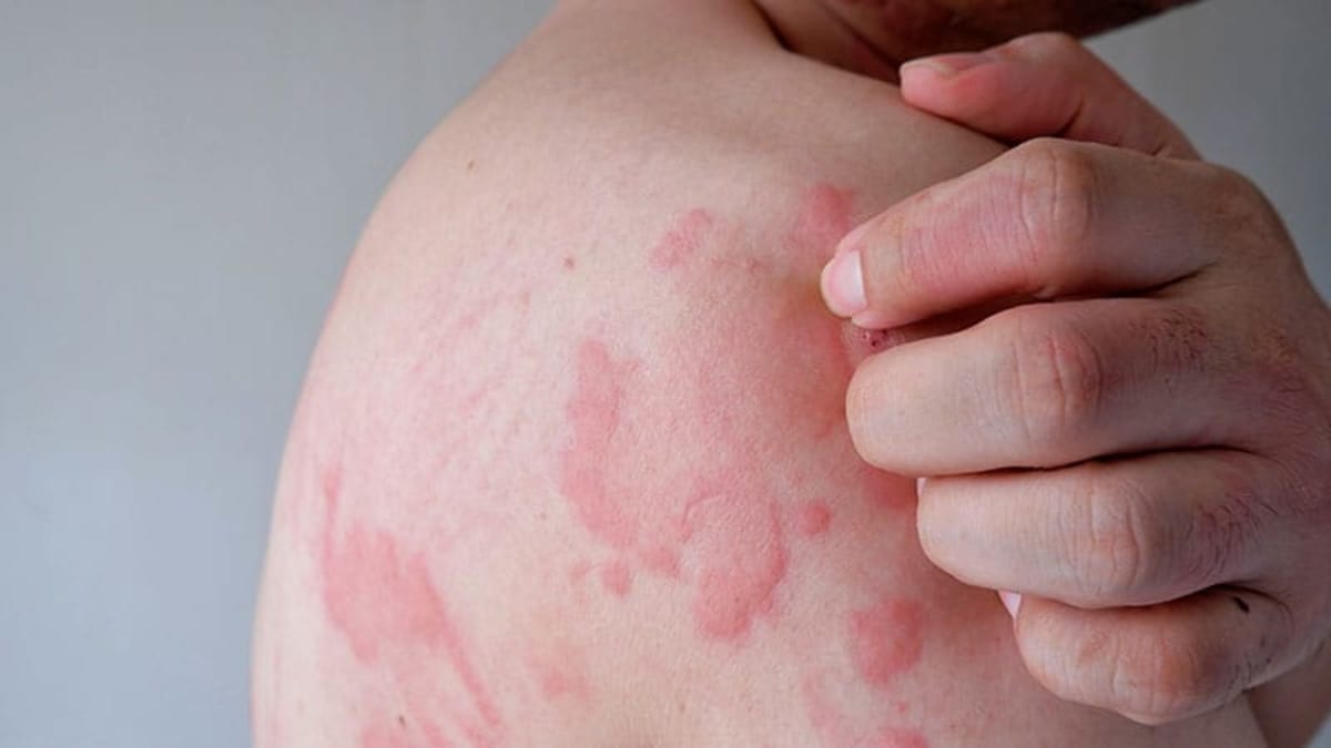 New Pill Frees Chronic Hives Patients From Constant Itching