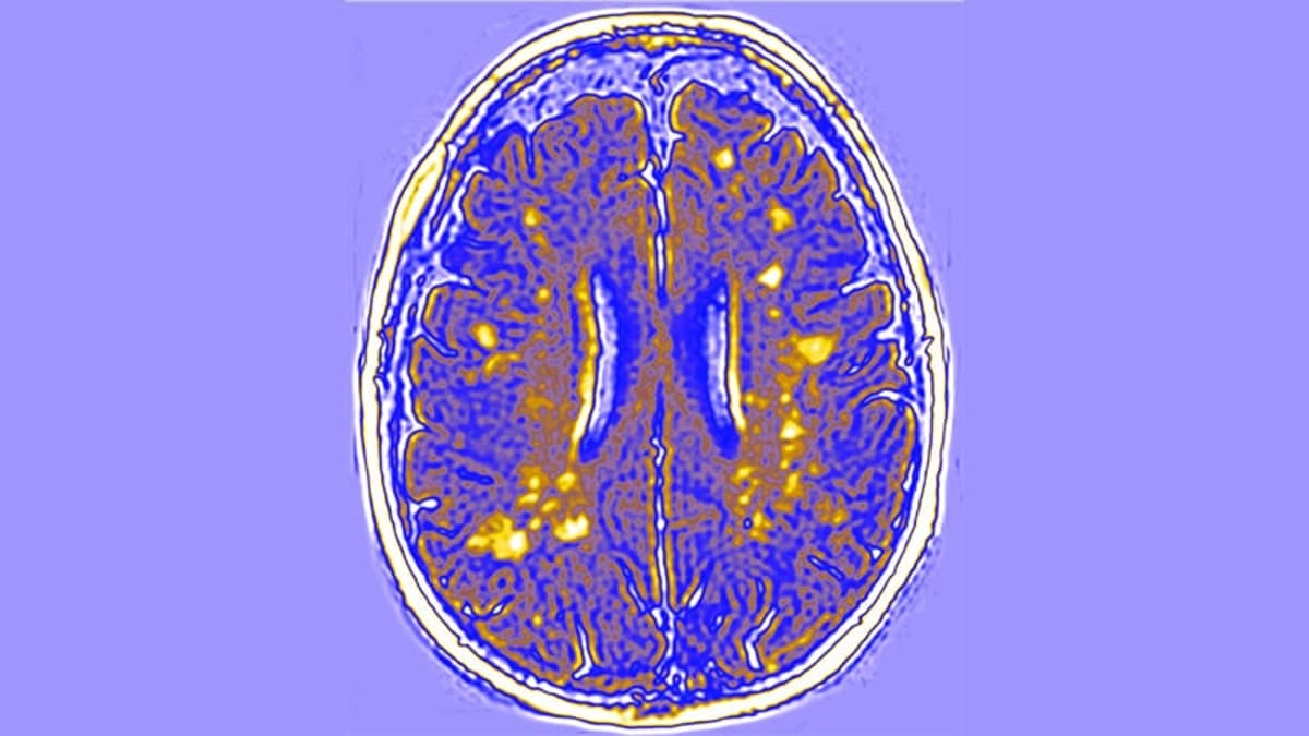 Old Blood Pressure Drug Helps Kids With Rare Brain Disease