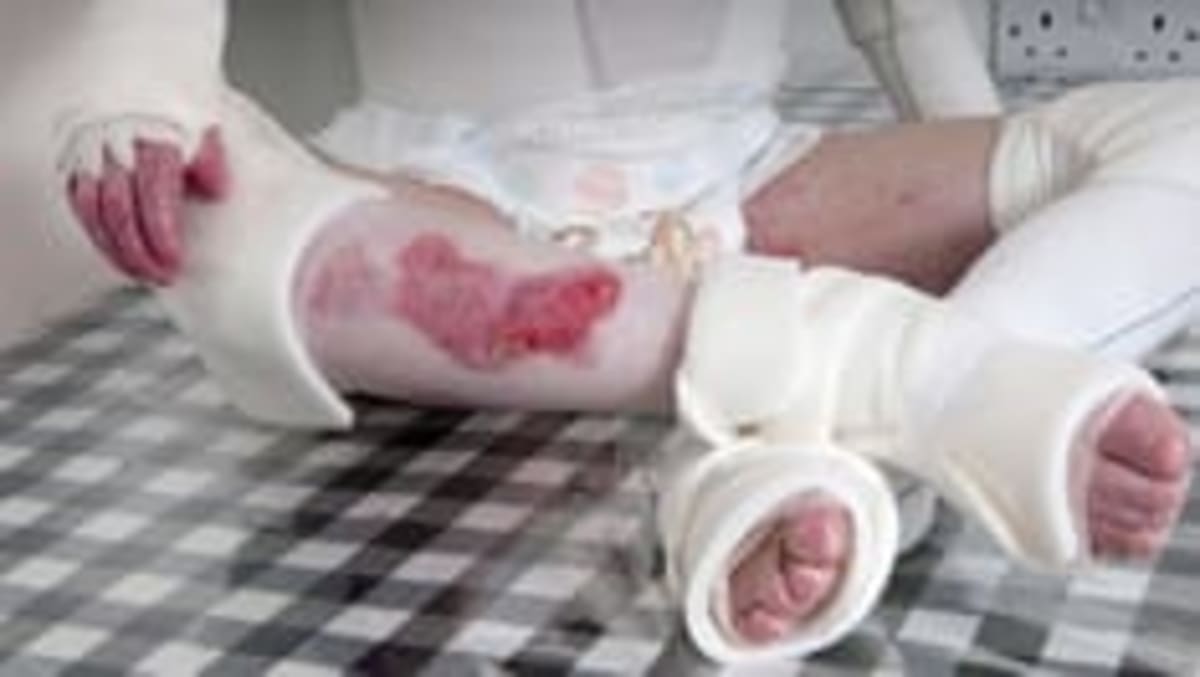 Gene Therapy Transforms Painful Skin Disease Treatment - Image 2