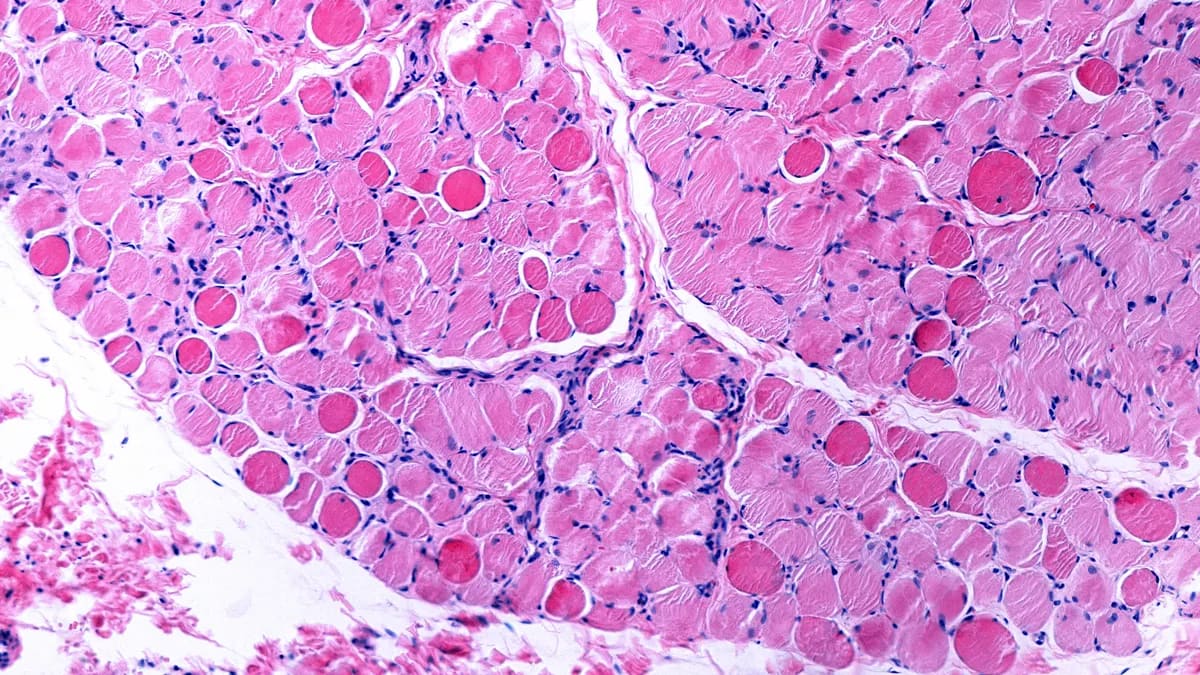 Gene Therapy Shows Promise for Duchenne Muscular Dystrophy - Image 3