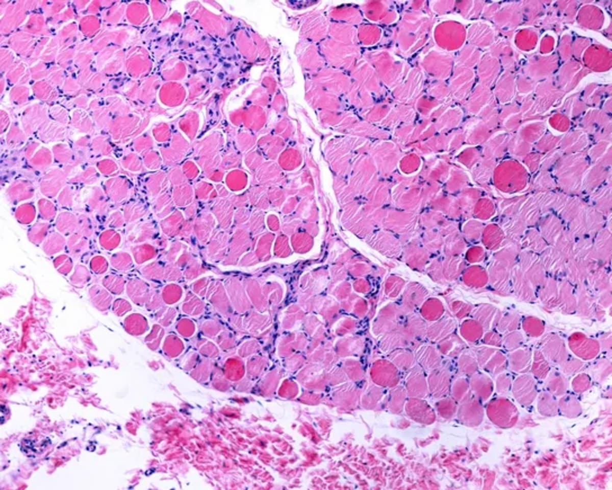 Microscope image showing muscle fiber structure in Duchenne muscular dystrophy research illustration