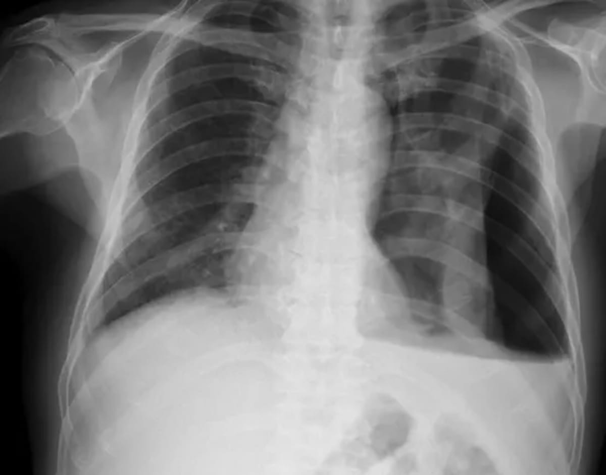 Radiologist reviewing chest X-ray images on computer screen with AI assistance technology