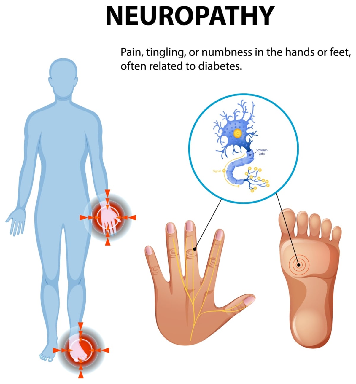 Chili Pepper Cream Brings Relief to Diabetic Nerve Pain - Image 4