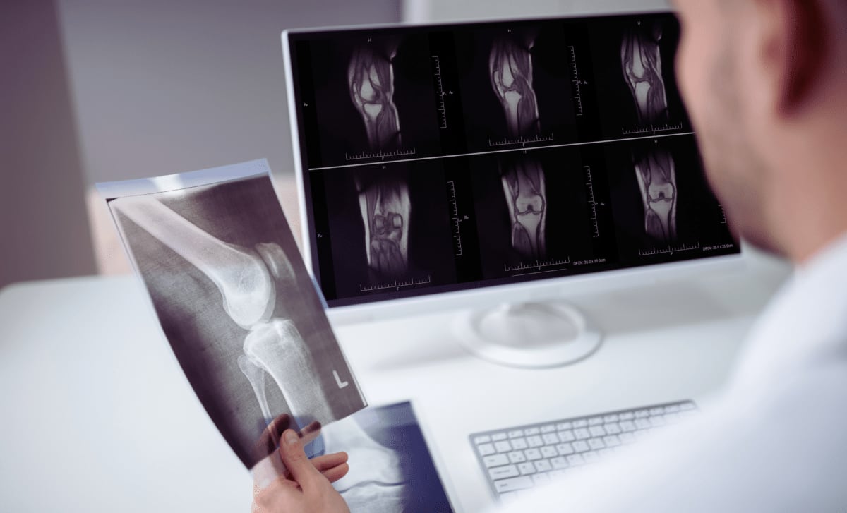 Scientists May Reverse Osteoporosis With New Bone Therapy