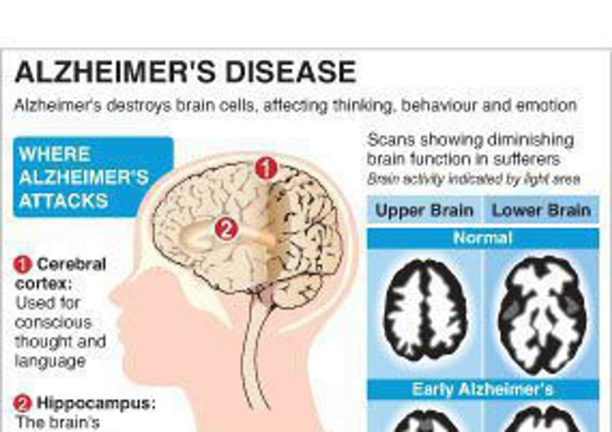 Cambridge Scientists Find Molecule That Stops Alzheimer's