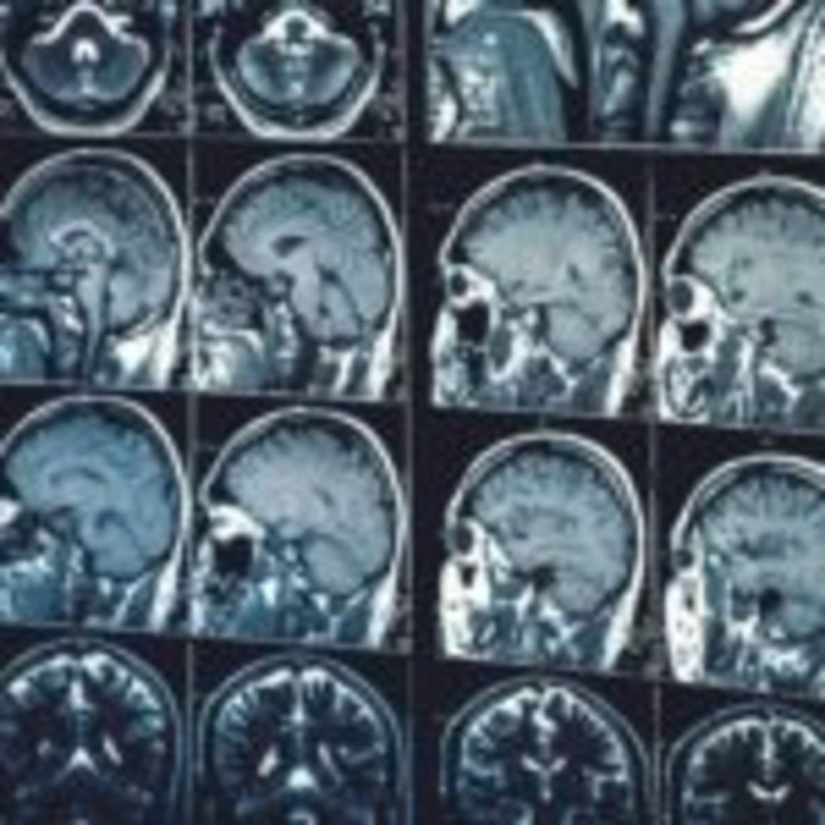 Brain Atlas From 54,000 Scans Could Detect Disease Early - Image 3