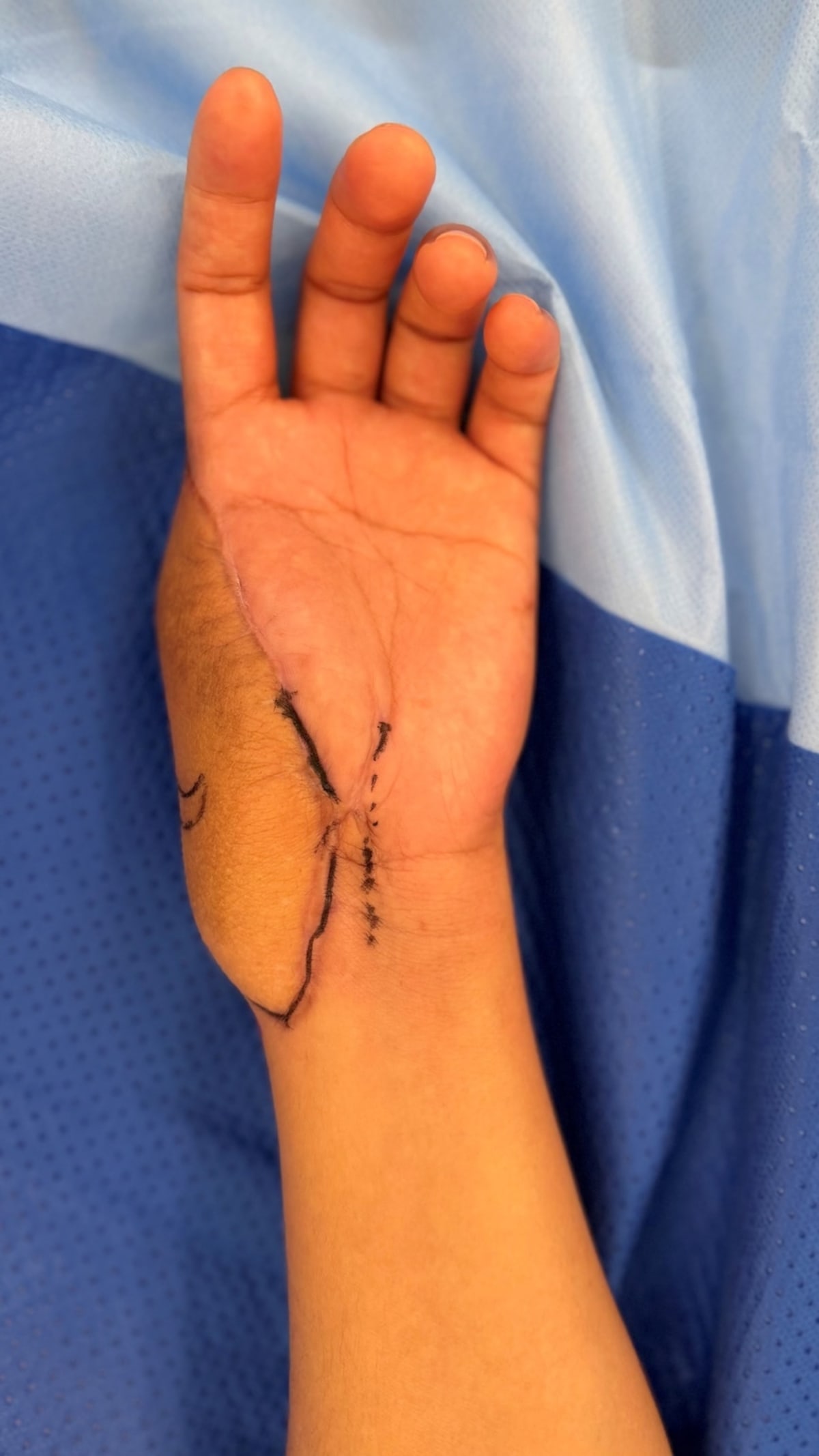Surgeon Gives Woman New Thumb Made from Her Own Toe - Image 4