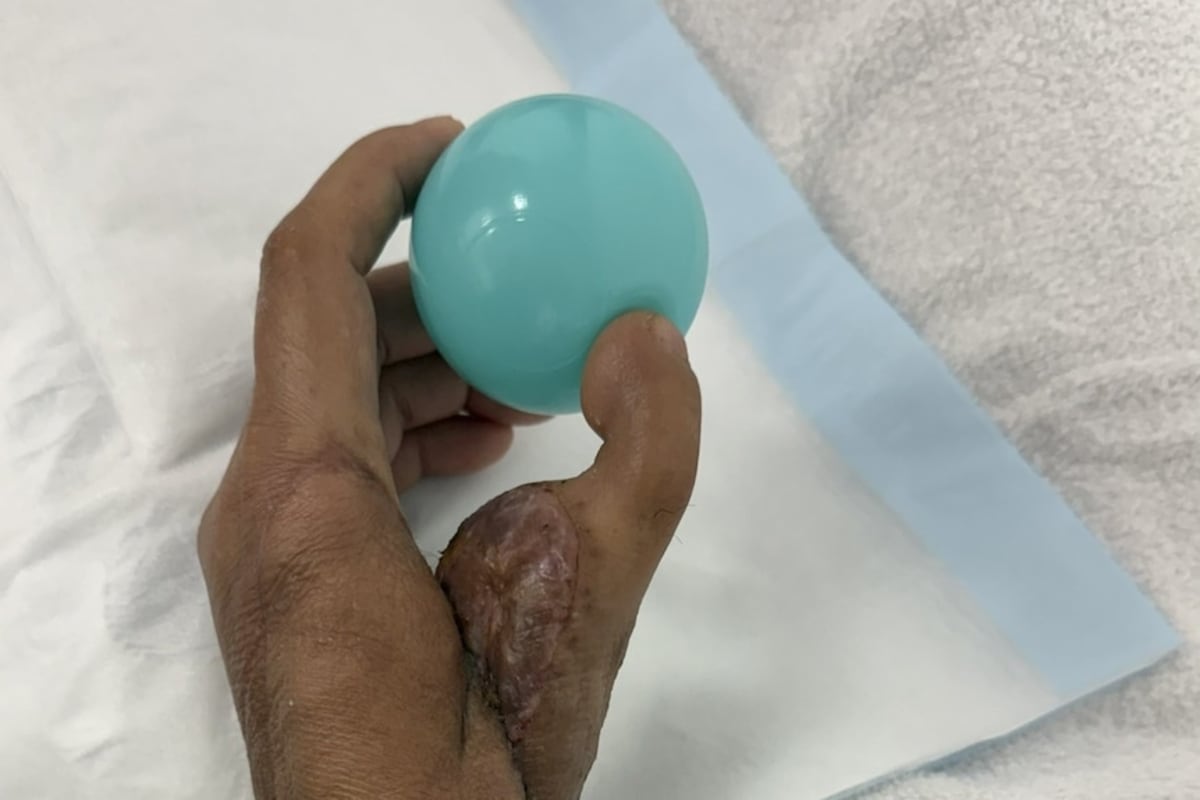 Surgeon Gives Woman New Thumb Made from Her Own Toe - Image 5