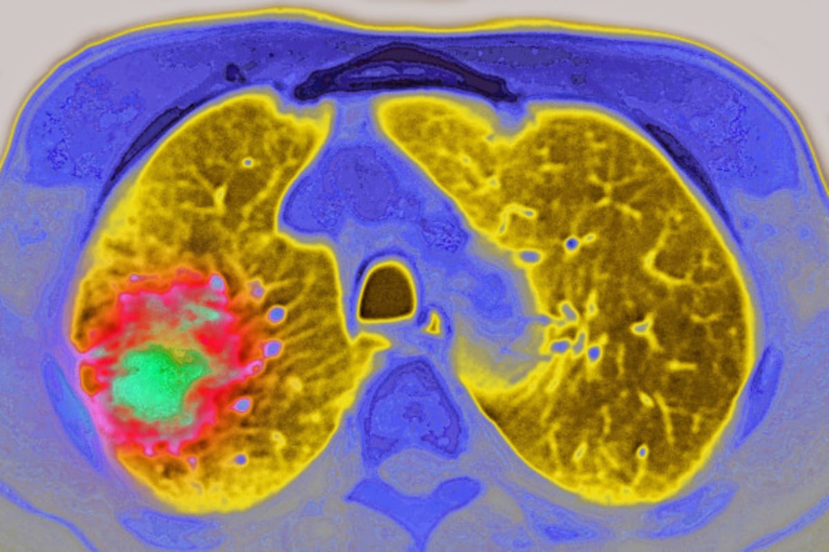 GLP-1 Drugs Cut Cancer Spread Risk by 50% in New Study - Image 3
