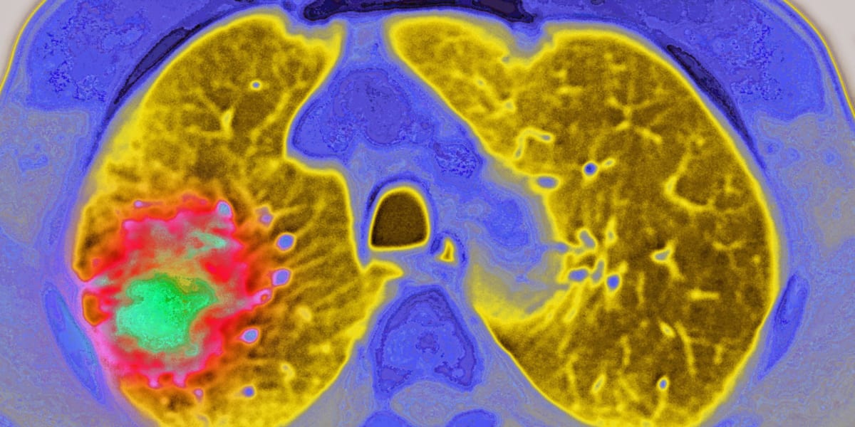 GLP-1 Drugs Cut Cancer Spread Risk by 50% in New Study - Image 2