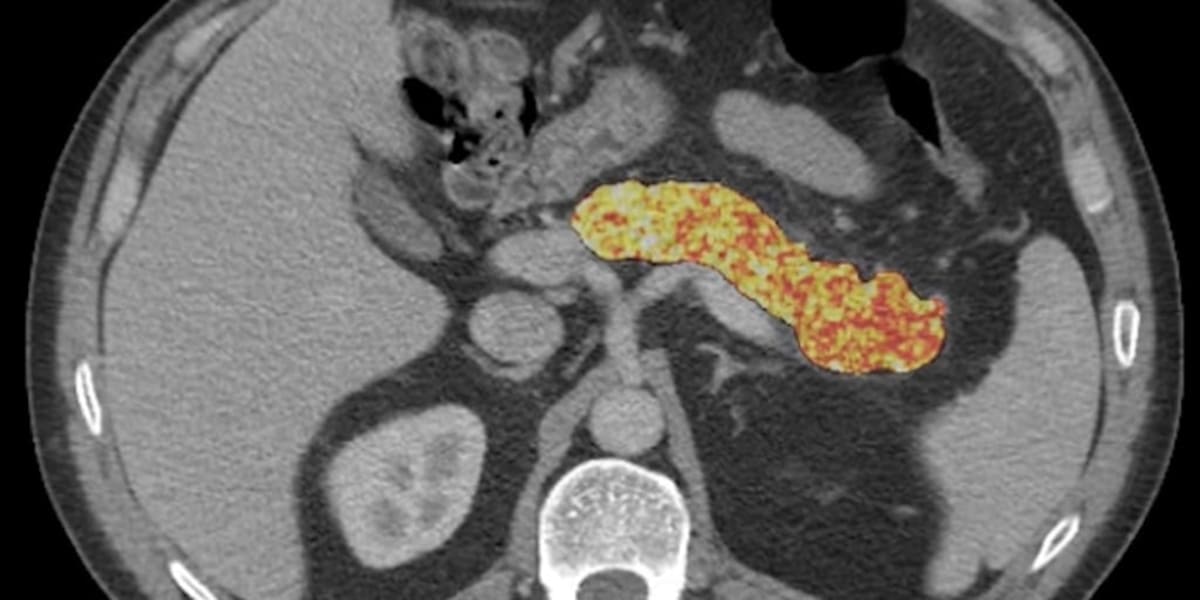 AI Spots Pancreatic Cancer 3 Years Before Diagnosis - Image 2