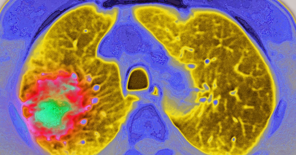 GLP-1 Drugs Cut Cancer Spread Risk by 50% in New Study