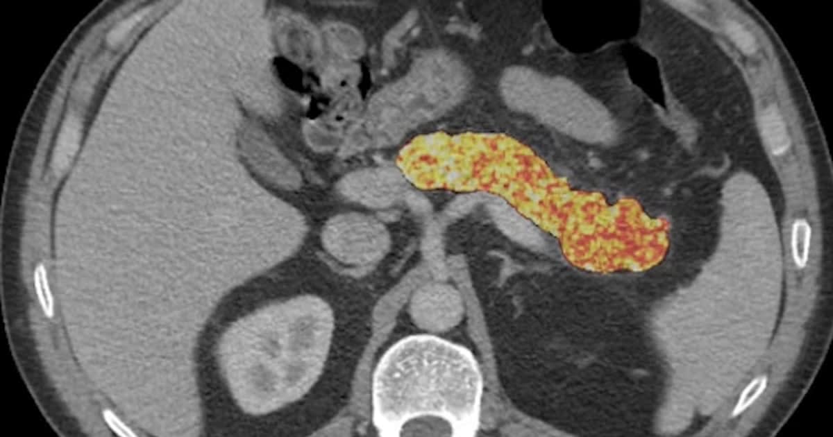 AI Spots Pancreatic Cancer 3 Years Before Diagnosis