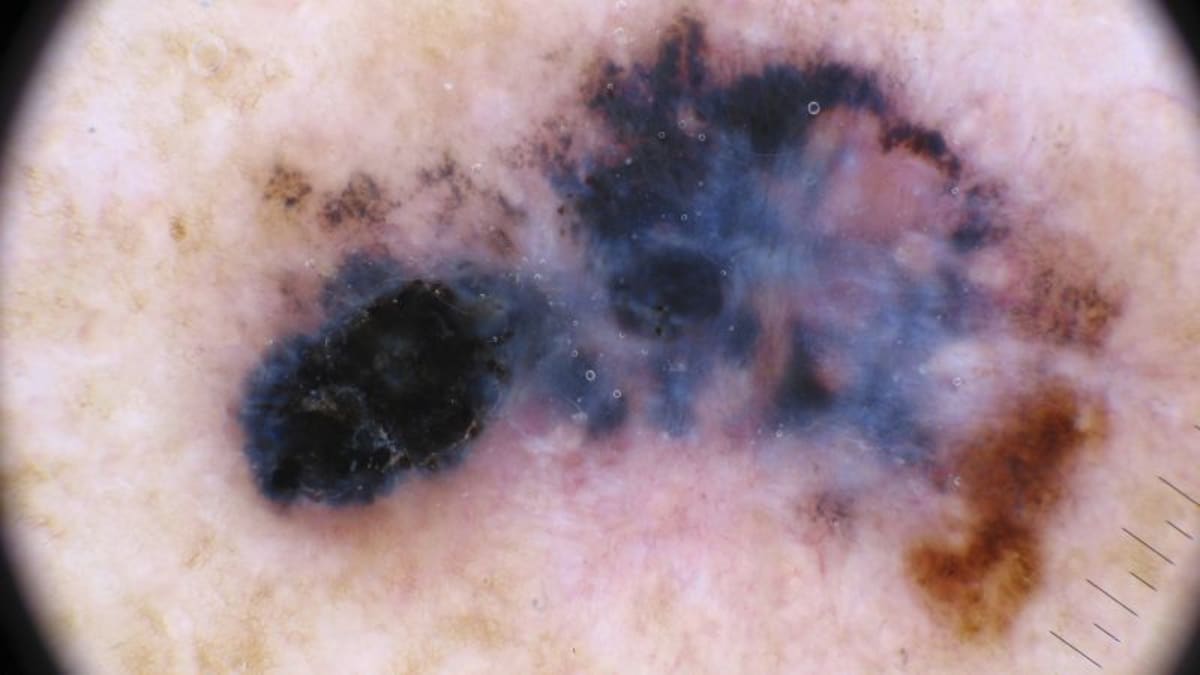 Moderna Cancer Vaccine Cuts Melanoma Return Risk by Half