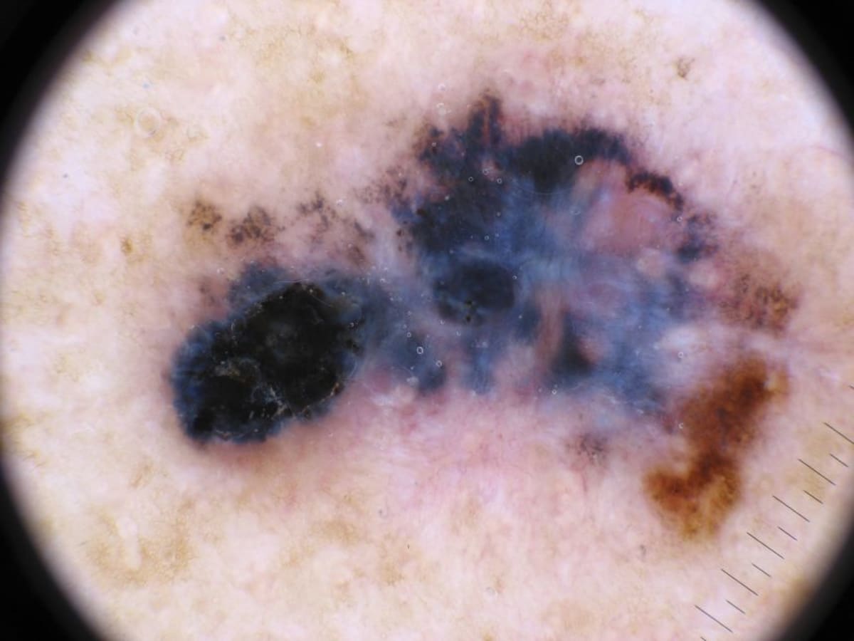 Moderna Cancer Vaccine Cuts Melanoma Return Risk by Half - Image 2