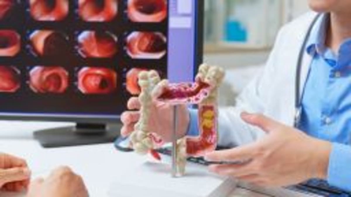 Blood Test Now Approved for Colon Cancer Screening - Image 3