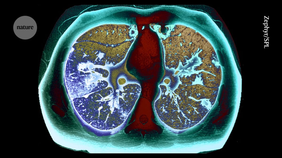 CT scan showing lungs during routine cancer screening examination in England