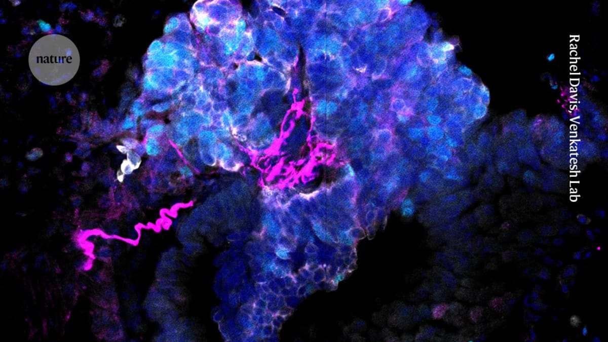 ** Microscope image showing magenta-colored neurons connecting with small-cell lung cancer tumor cells