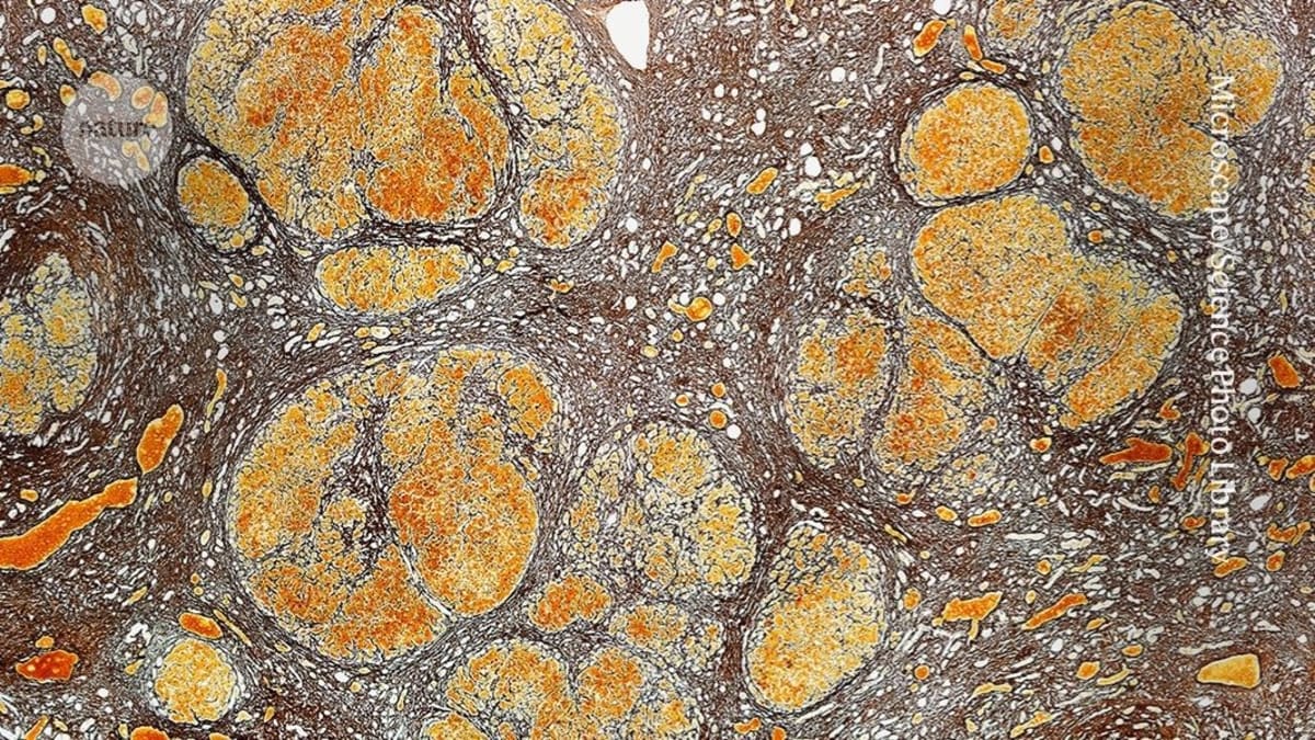Immune Cell Therapy Cuts Cirrhosis Death Risk in Trial