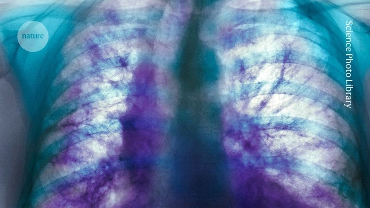 New Drug Shows Promise for Incurable Lung Disease