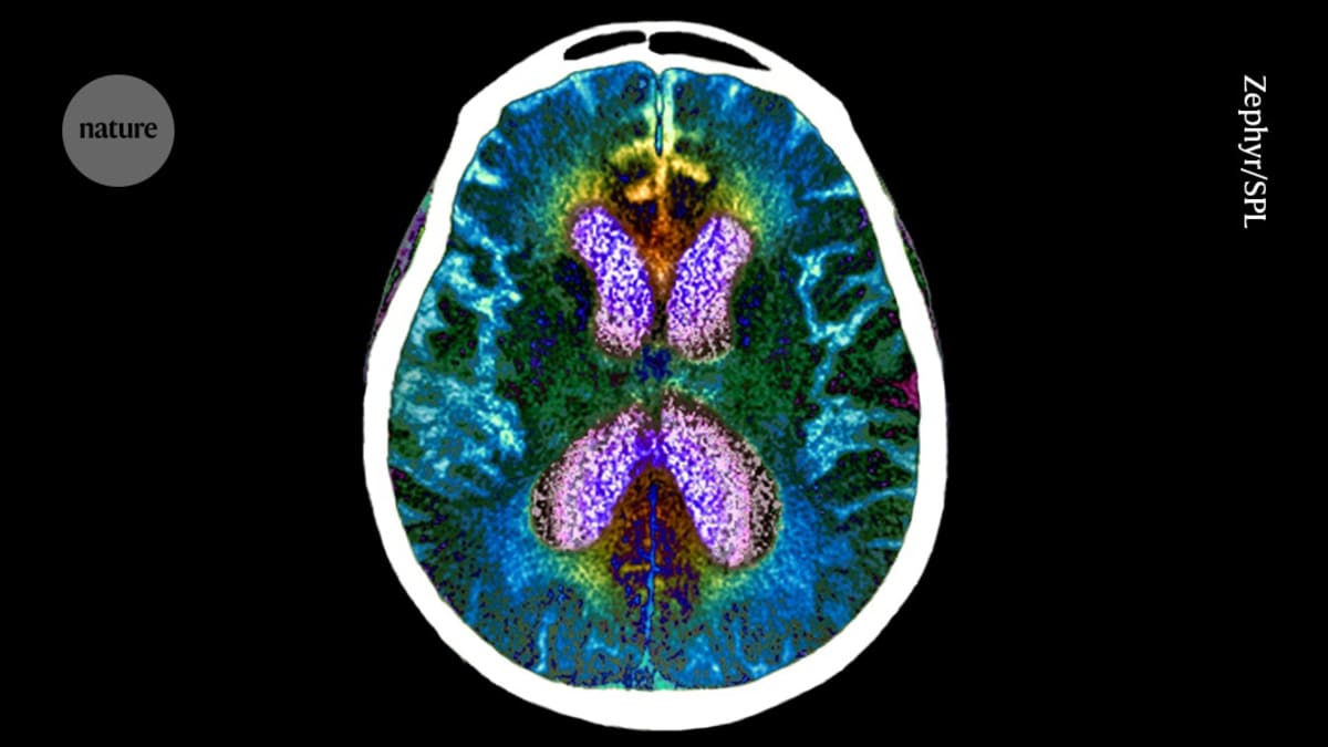 New Brain Resilience Test Predicts Alzheimer's Risk Better