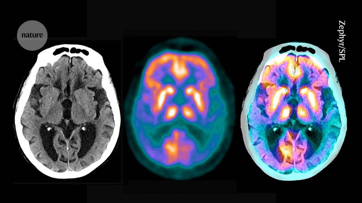 Scientists Map 1,000+ Brain Proteins Linked to Alzheimer's