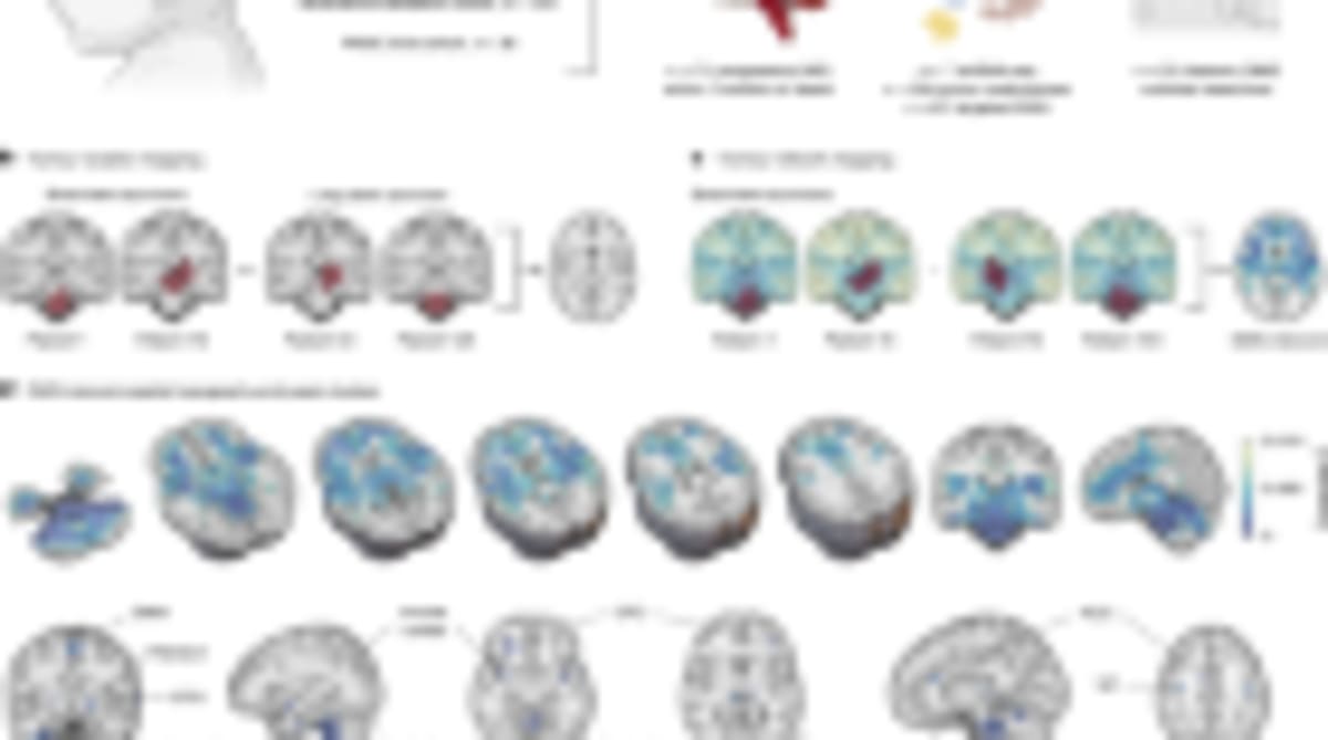 Brain Implant Helps ALS Patient Work and Connect at Home - Image 4