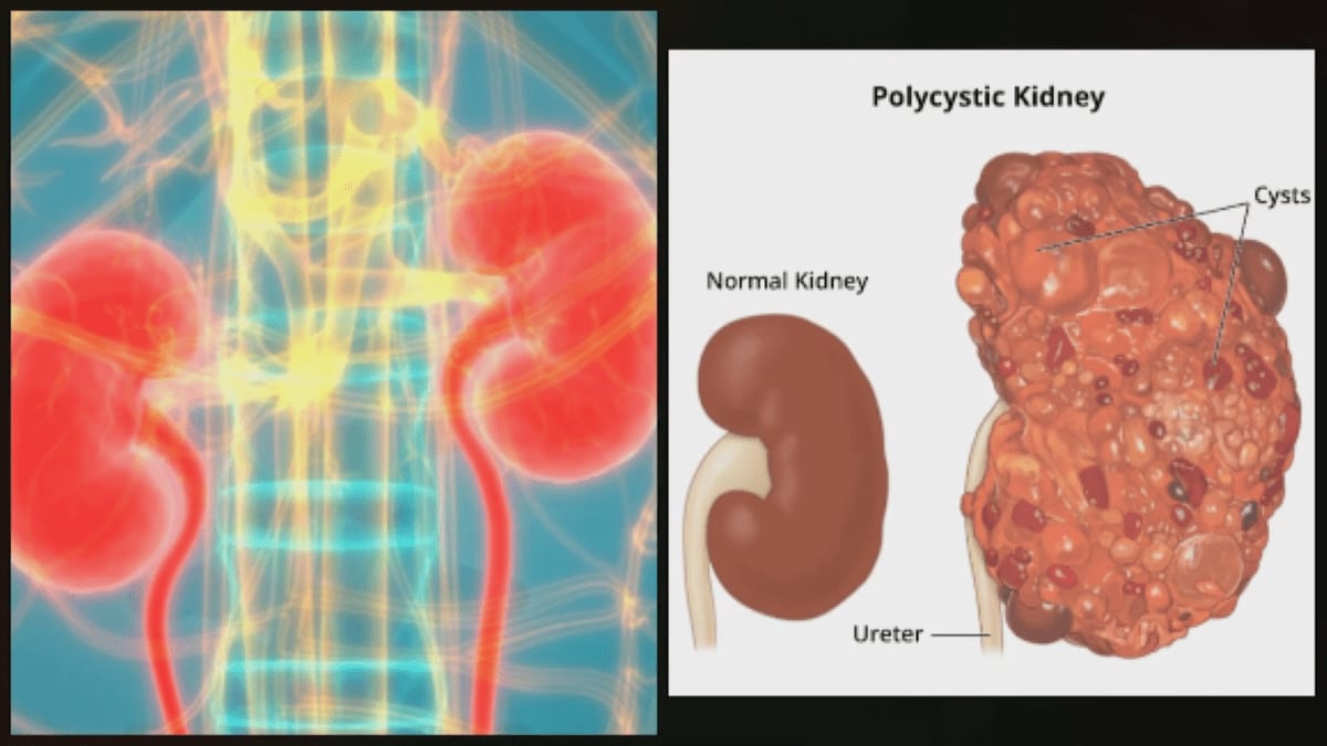 New PKD Cures Act Could Help Millions With Kidney Disease