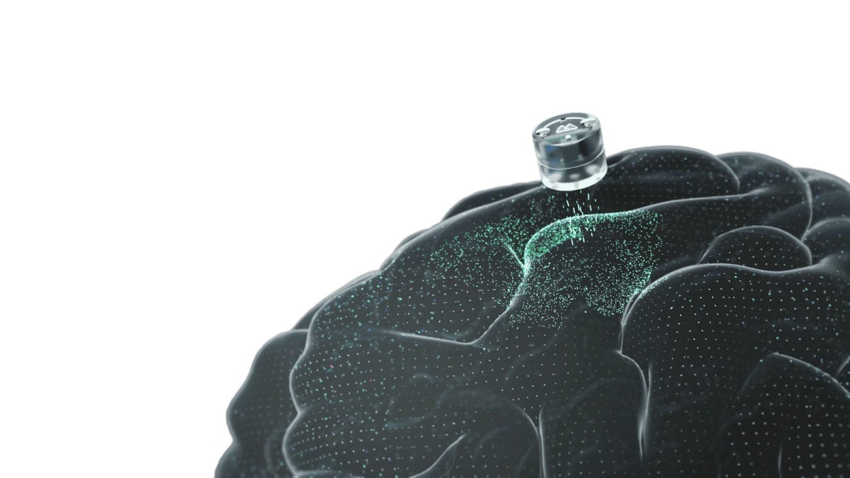 FDA Approves Brain Implant Trial for Severe Depression - Image 2