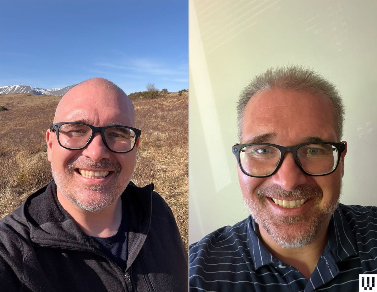 FDA-Cleared LED Cap Regrows Hair After 15 Years of Baldness - Image 2