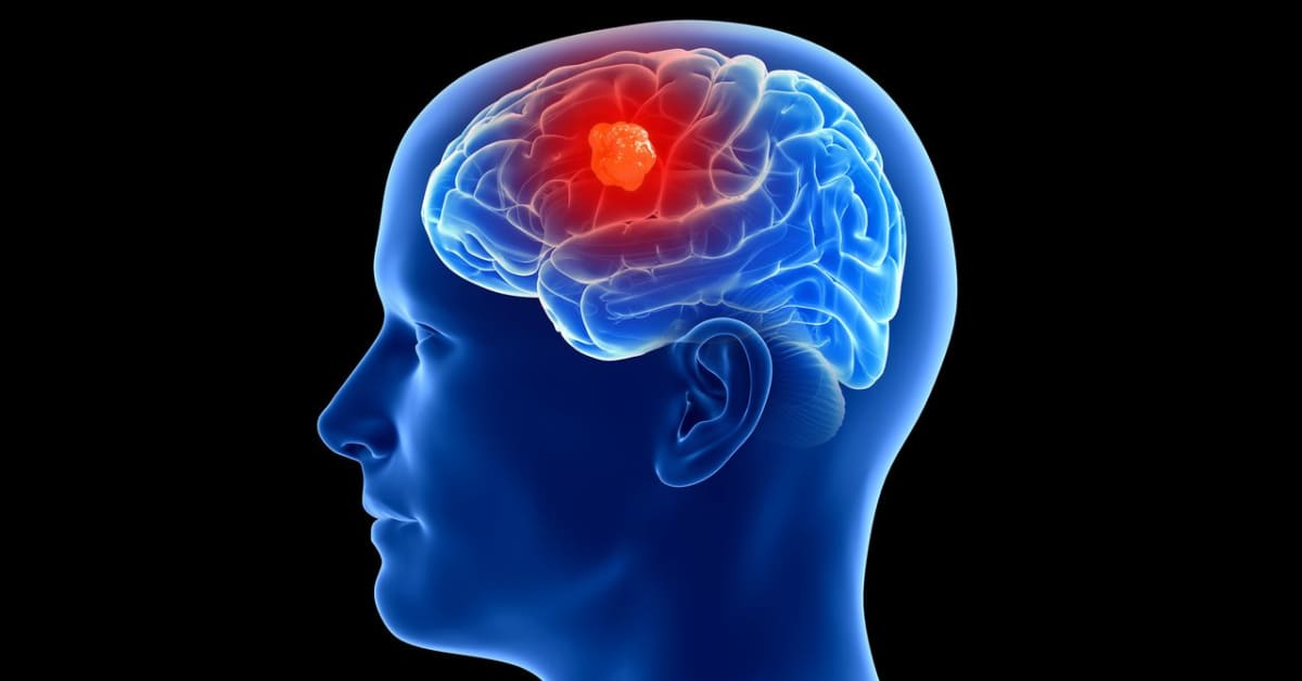 Brain Implant Detects Cancer in First 3 Human Patients