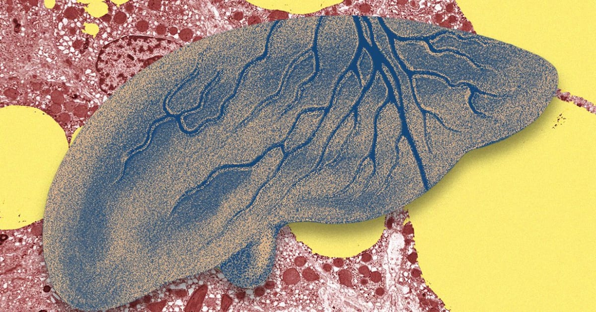 AI Spots Fatty Liver Disease Early, Saving Lives