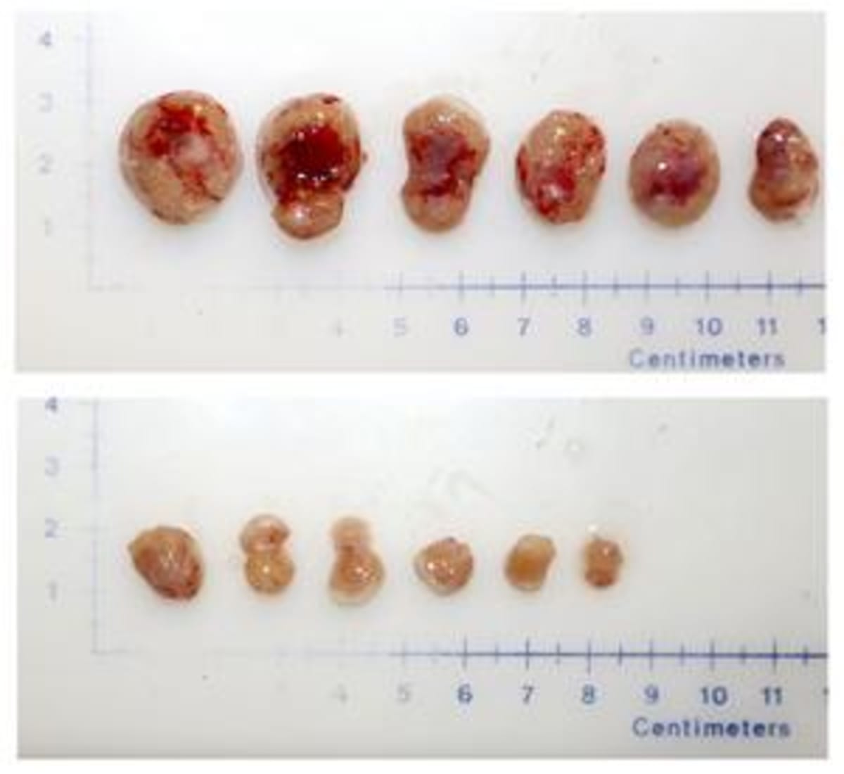 New Drug Target Could Stop Aggressive Prostate Cancer
