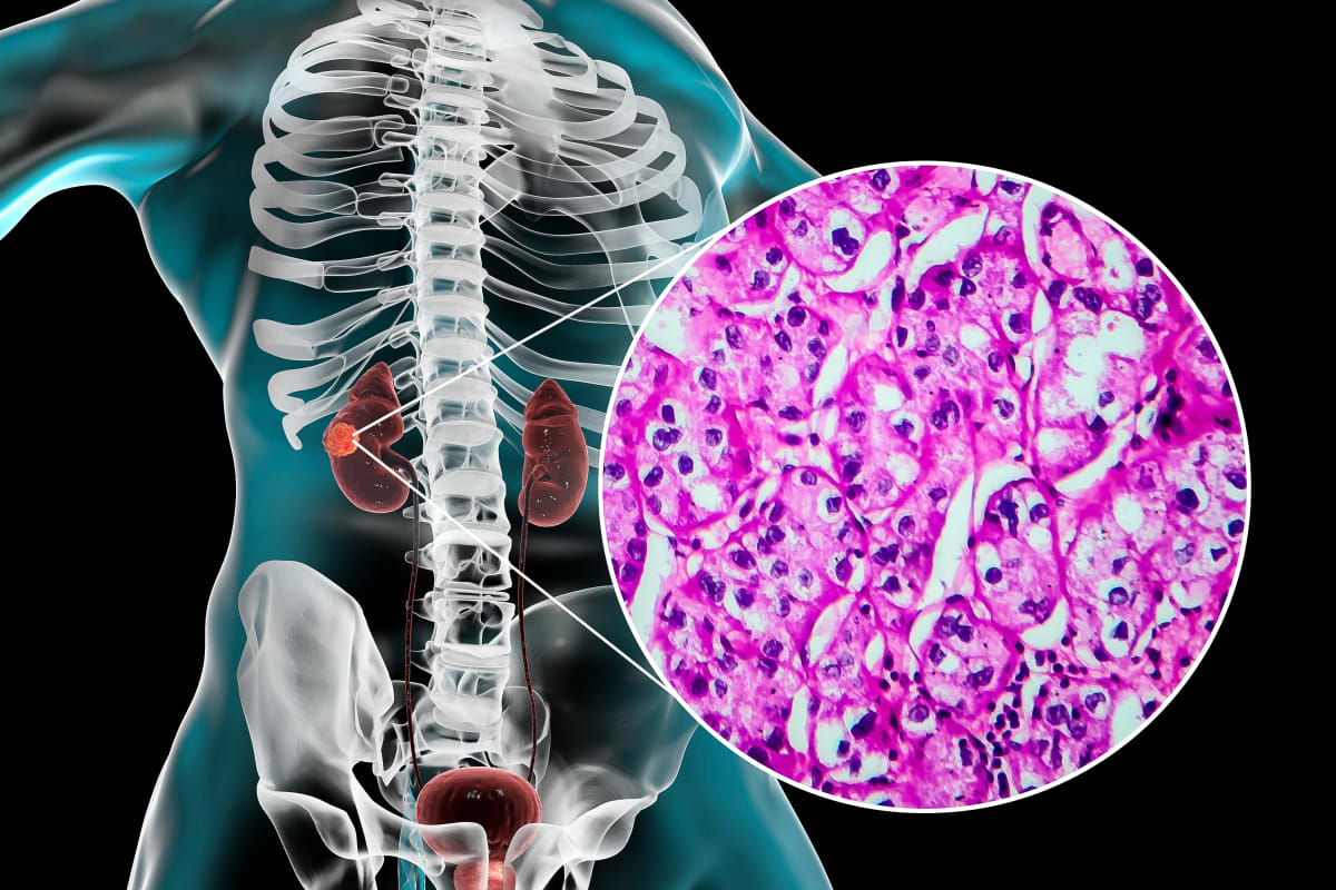 FDA Approves New Combo Treatment for Kidney Cancer Patients - Image 2