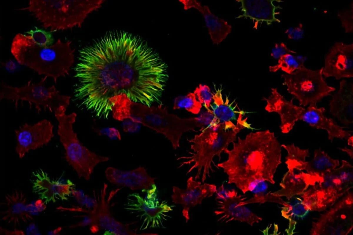80% of Rectal Cancer Patients Keep Their Rectum in New Trial - Image 5