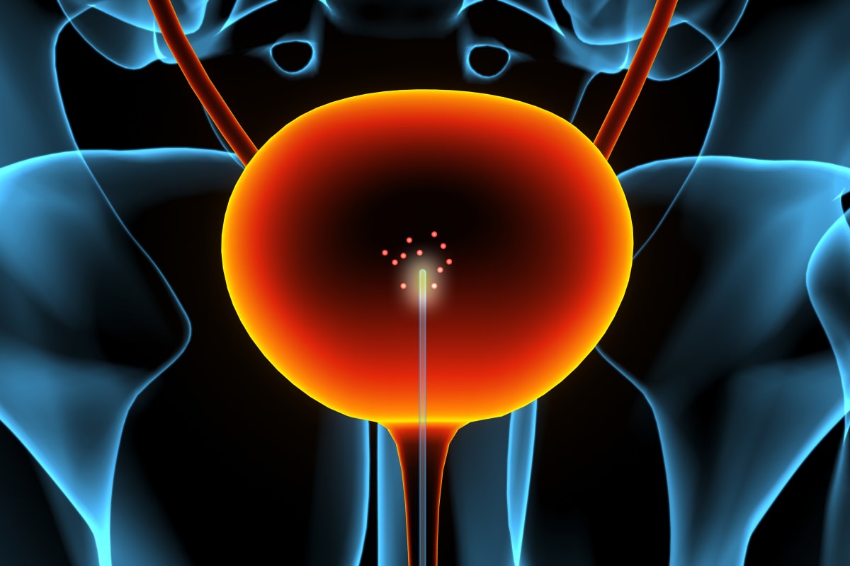 MIT Sensor Detects Bladder Cancer 180 Times Earlier