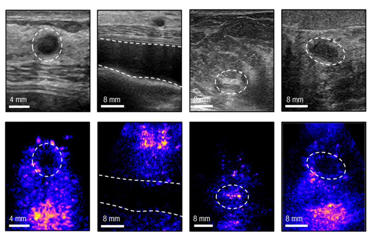 MIT Creates At-Home Breast Cancer Scanner Anyone Can Use