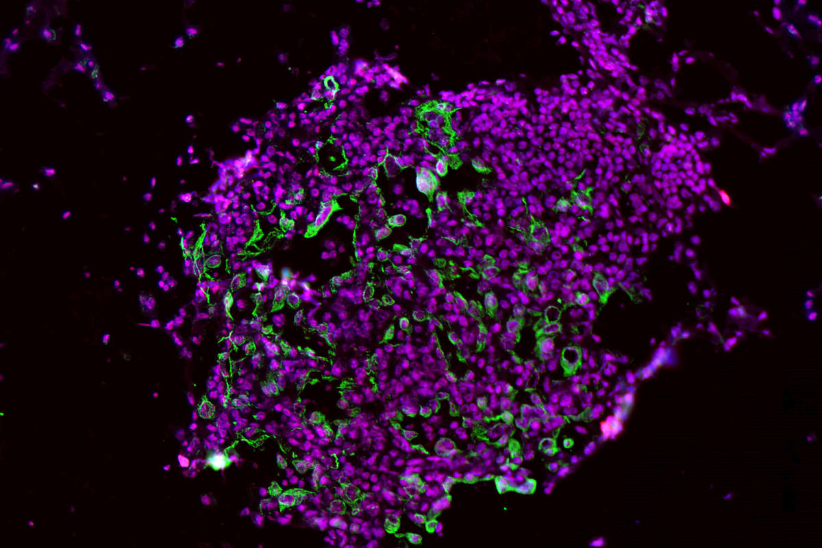 Microscope image showing lung tumor cells with high levels of caspase-1 enzyme in green and red