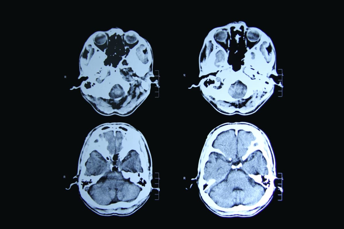 Medical researcher examining brain scan images in laboratory studying Huntington disease