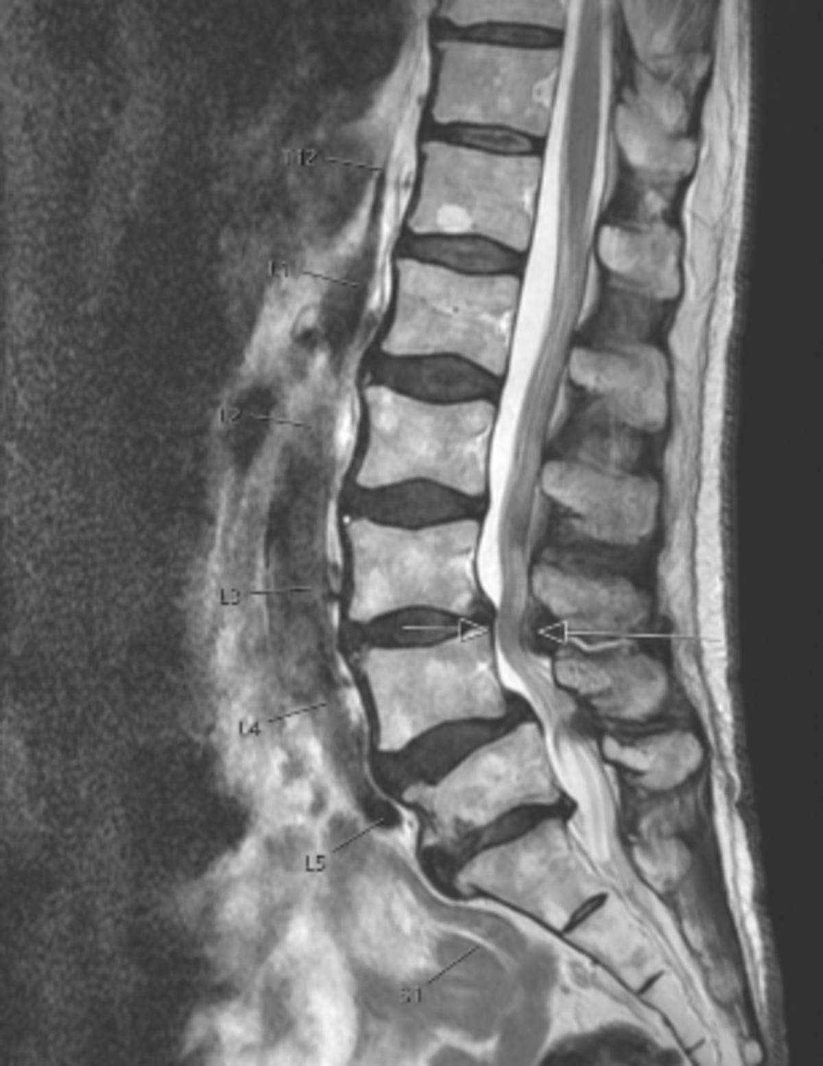 Scientists Find Stem Cells That May Treat Back Pain - Image 4