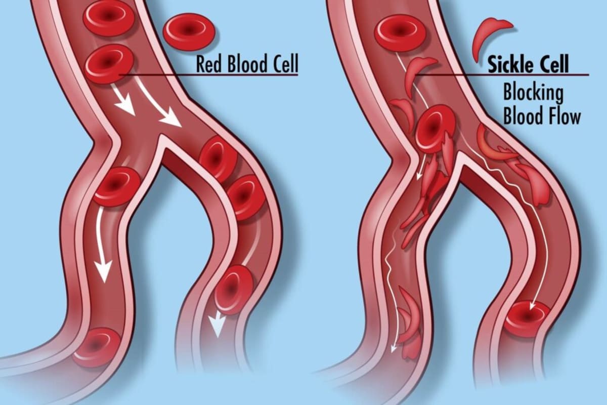 Gene Therapy Cures Sickle Cell in 27 of 28 Patients