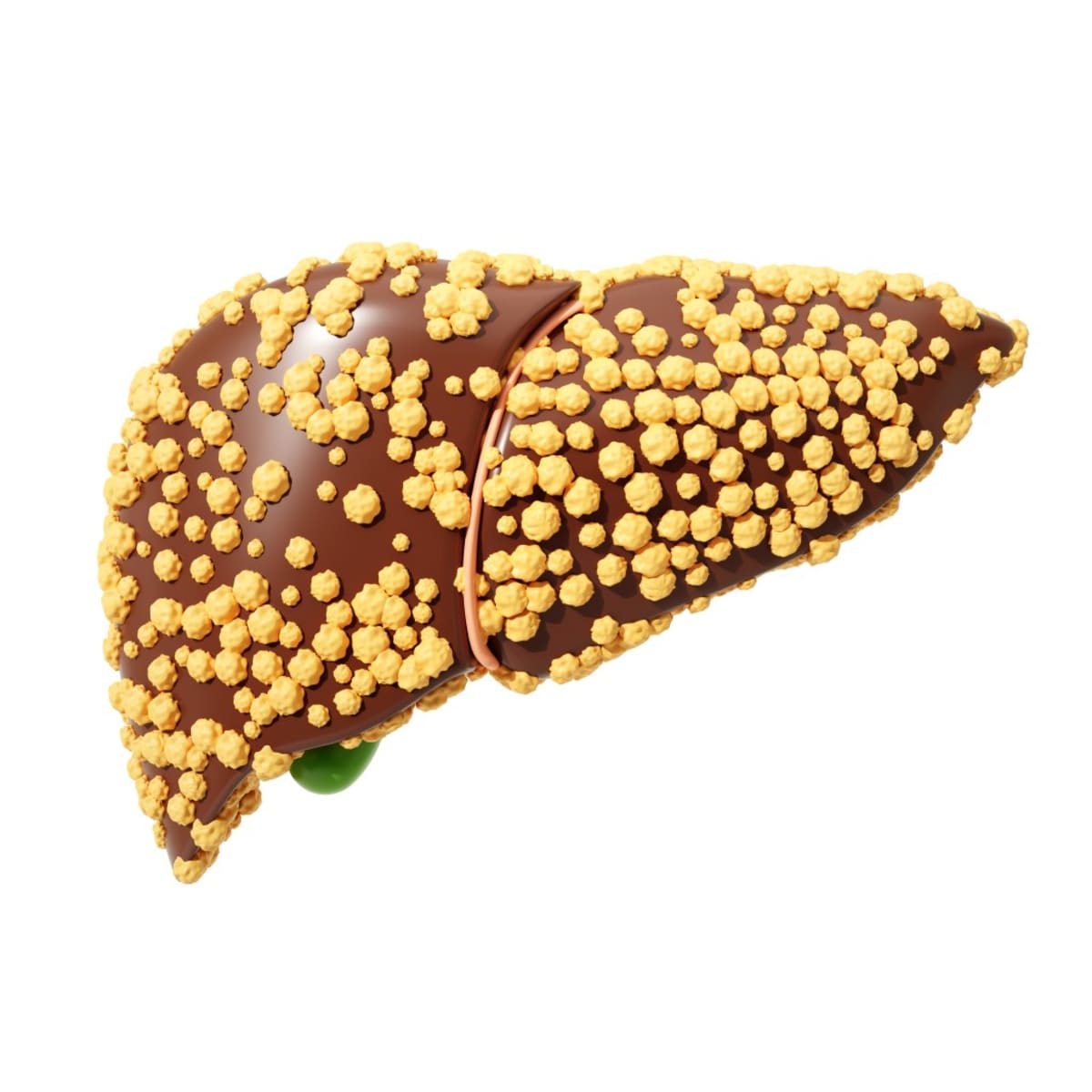 UCLA Scientists Reverse Fatty Liver Disease in Breakthrough - Image 4